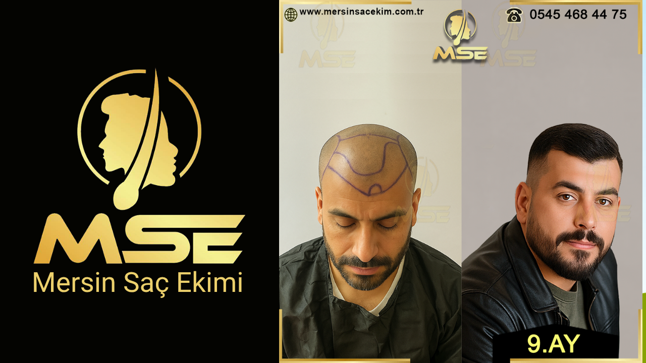 MERSİN SAÇ EKİMİ